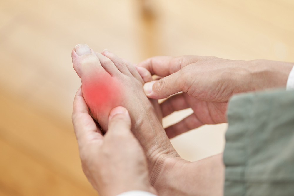Comment soulager une crise de goutte ?
