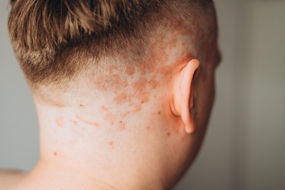 Comment débute un psoriasis ?