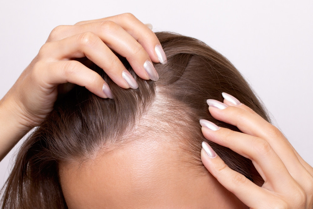 Quelle carence fait perdre ses cheveux ?