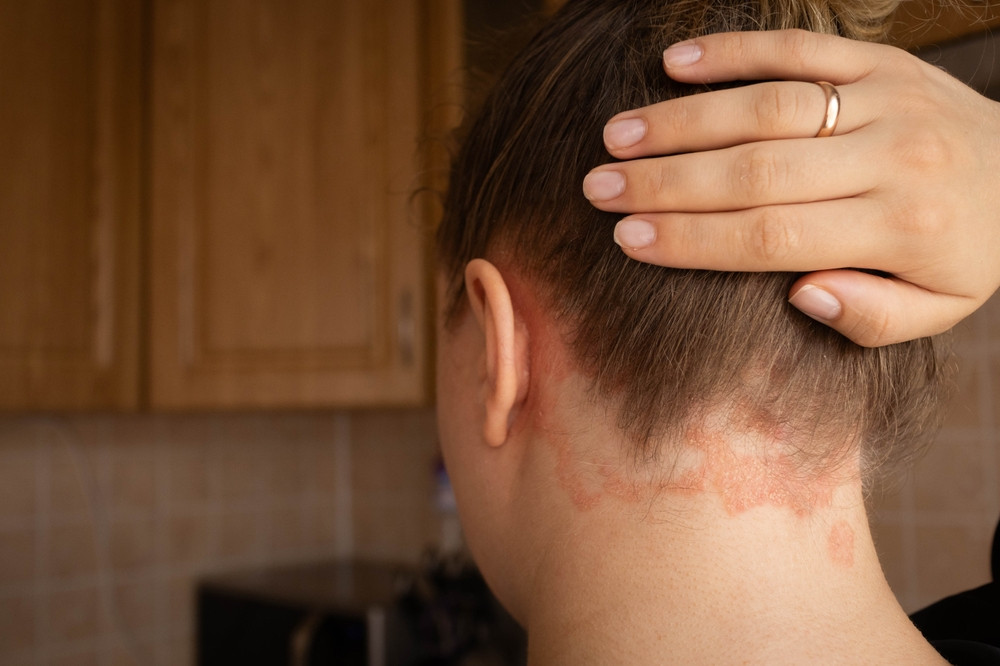 Comment savoir si on fait du psoriasis ?
