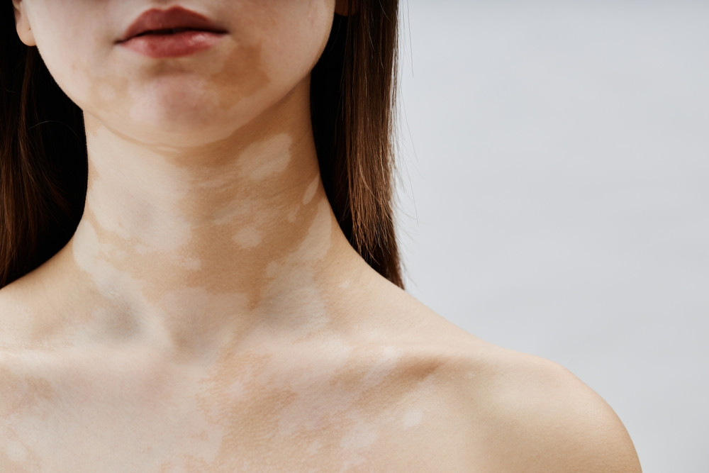 Est-ce que le vitiligo est contagieux ?
