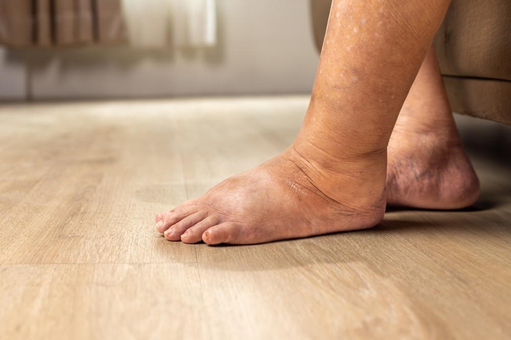 Comment faire dégonfler un œdème ?
