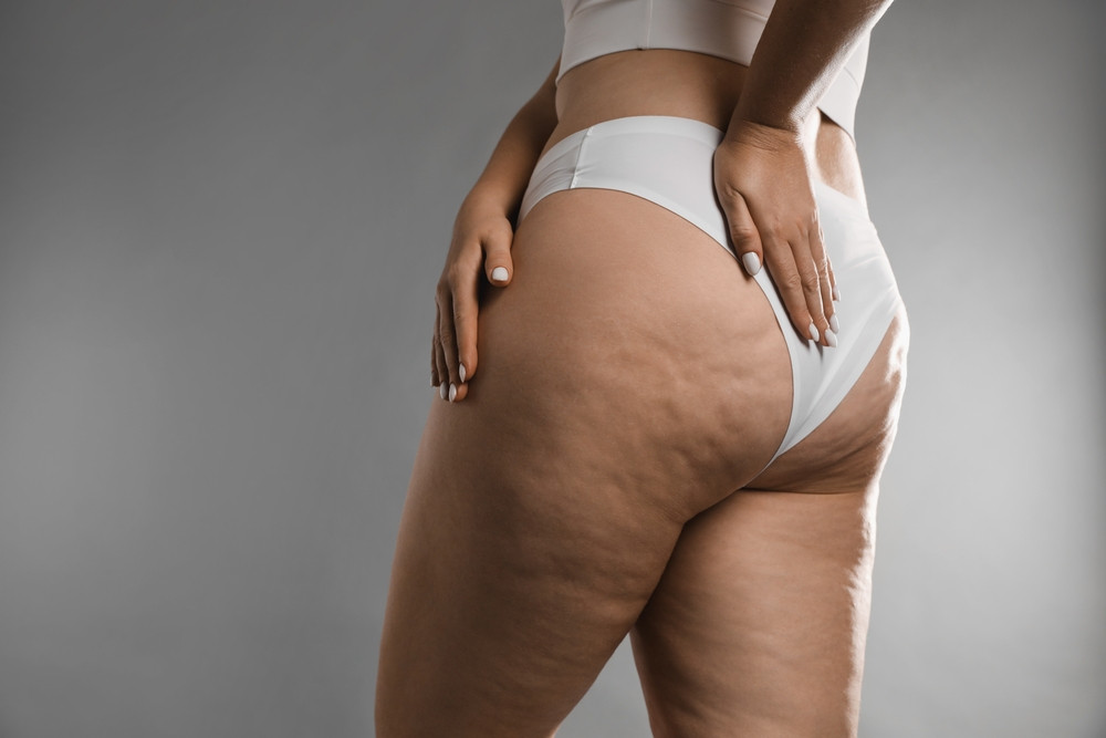 cellulite