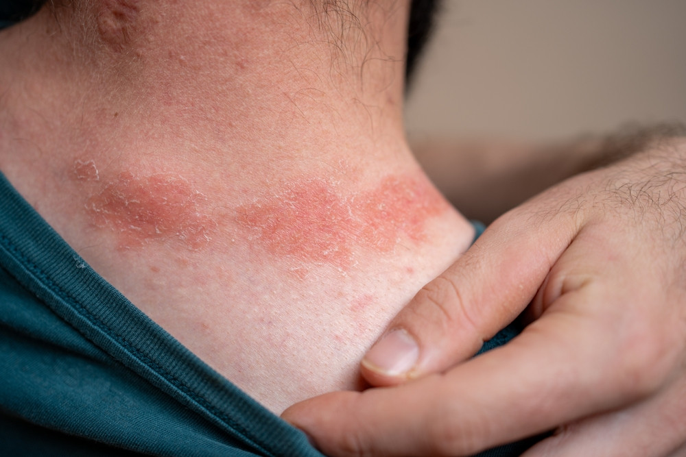 Quels sont les signes du psoriasis ?