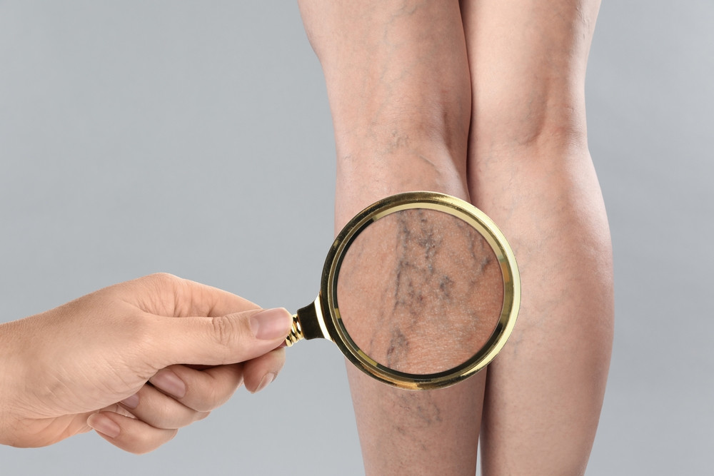Comment guérir une thrombose veineuse ?