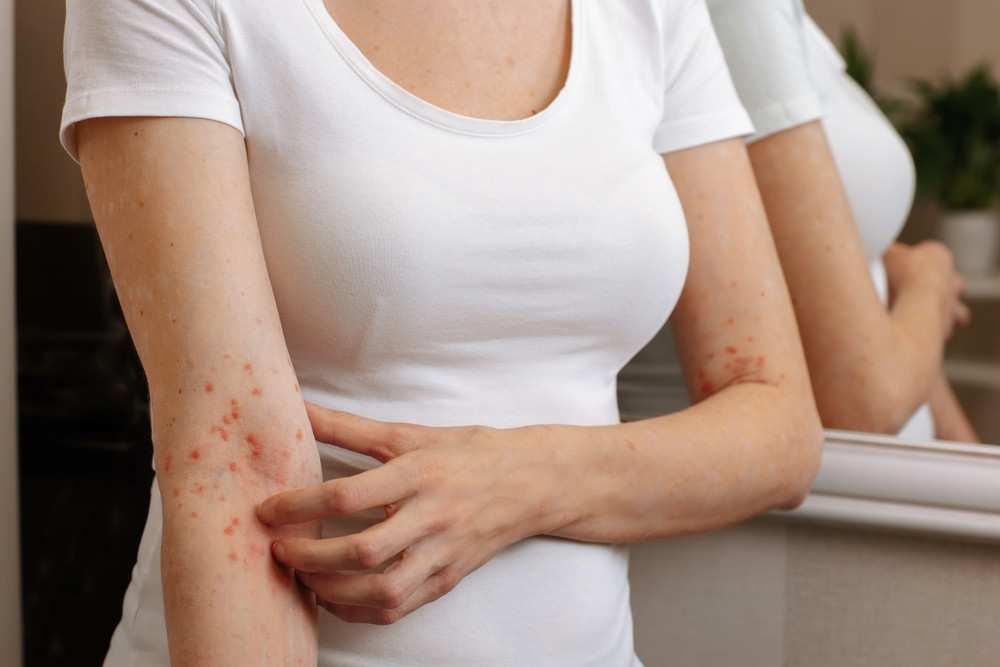Comment attrape-t-on la gale ?