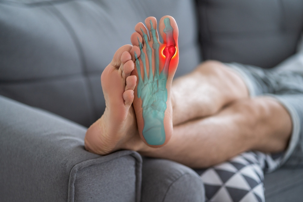 Tout savoir sur l’hallux valgus