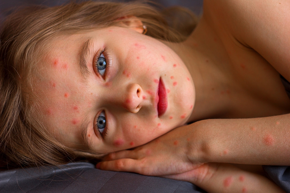 Comment soulager une varicelle ?