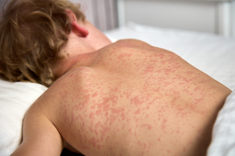 Comment soulager une rubéole ?