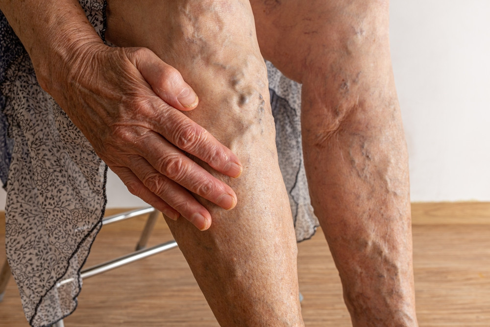 Quand s'inquiéter d'une thrombose ?