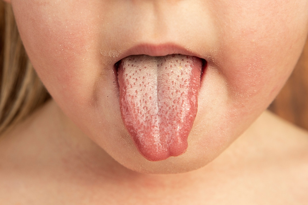 Comment soulager une scarlatine ?