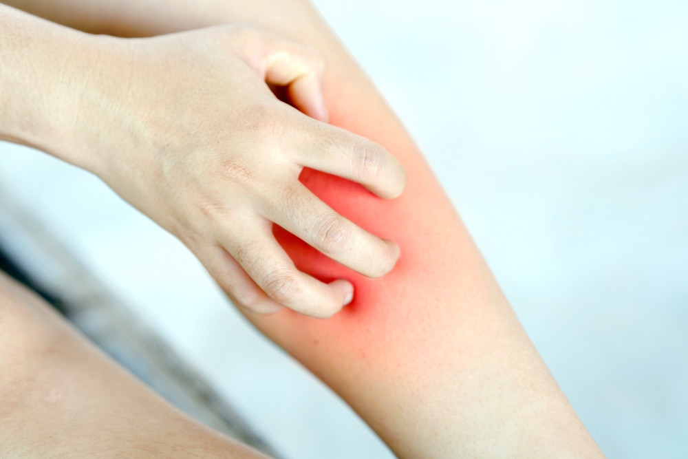 Tout savoir sur le syndrome du mollet qui gratte