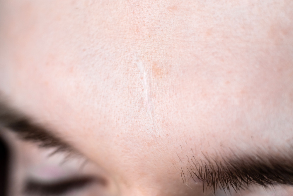 Pourquoi ne faut-il jamais exposer une cicatrice au soleil ?