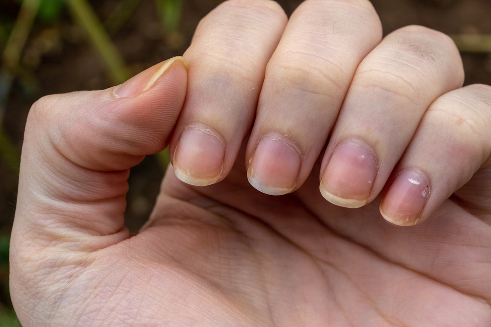 Ongles jaunis : quelles solutions ?