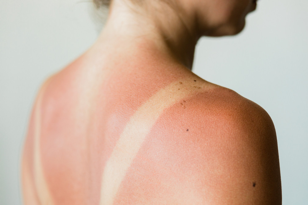 Comment bien dormir après un coup de soleil ?
