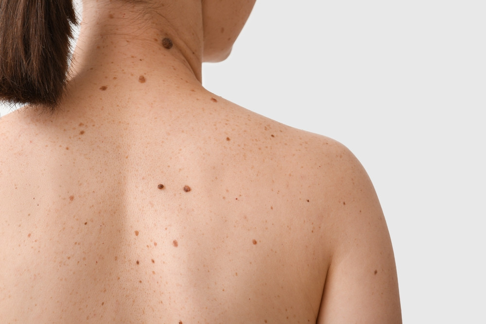 Comment réduire les risques de cancer de la peau ?