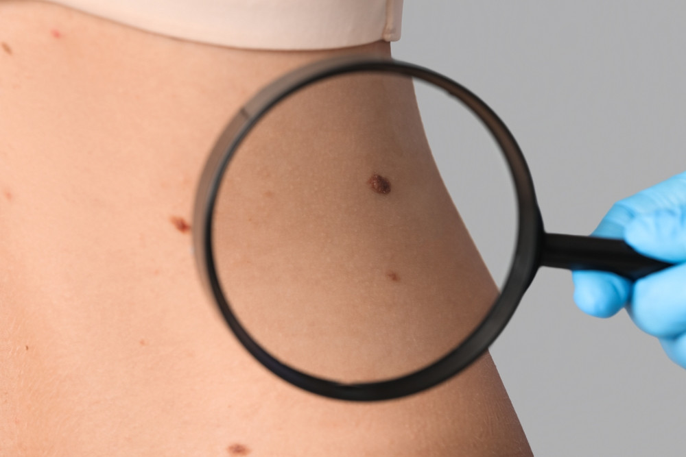 Cancer cutané : quels sont les signes ?
