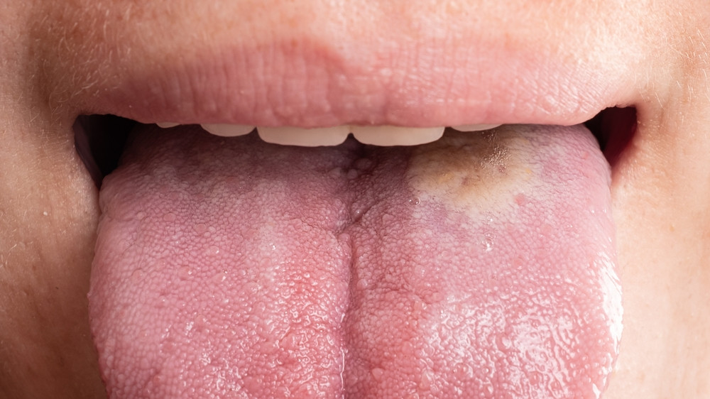 Comment réduire les risques de cancer de la langue ?