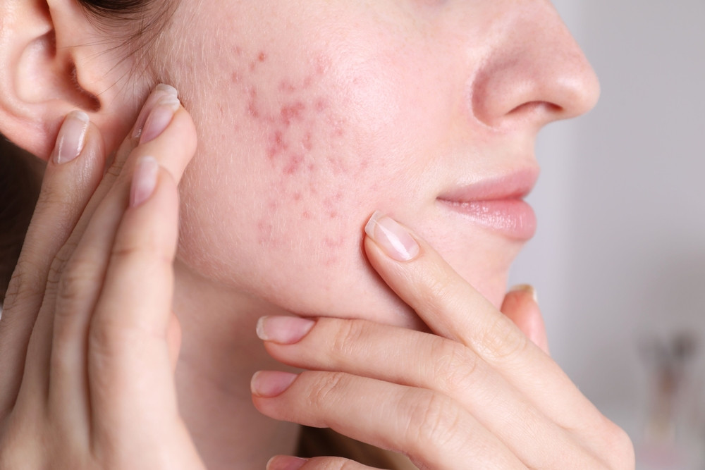 L’acné hormonale, c’est quoi ?