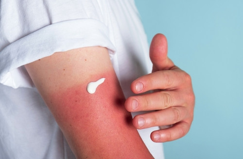 Combien de temps dure un coup de soleil ?