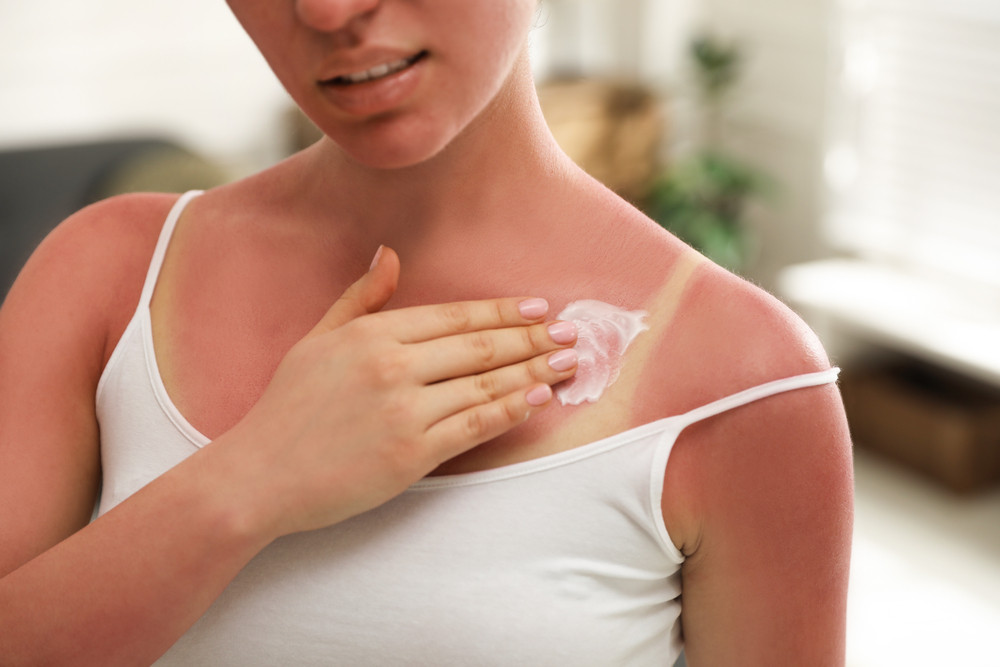 5 remèdes maison contre les coups de soleil