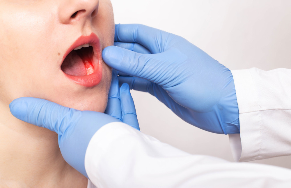 Cancer des gencives : quels sont les premiers signes ?