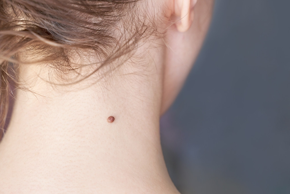 Grossesse : attention à vos grains de beauté !