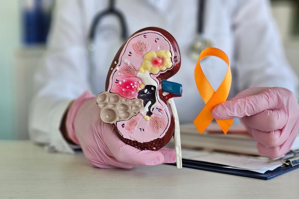 Cancer du rein : quels sont les premiers signes ?