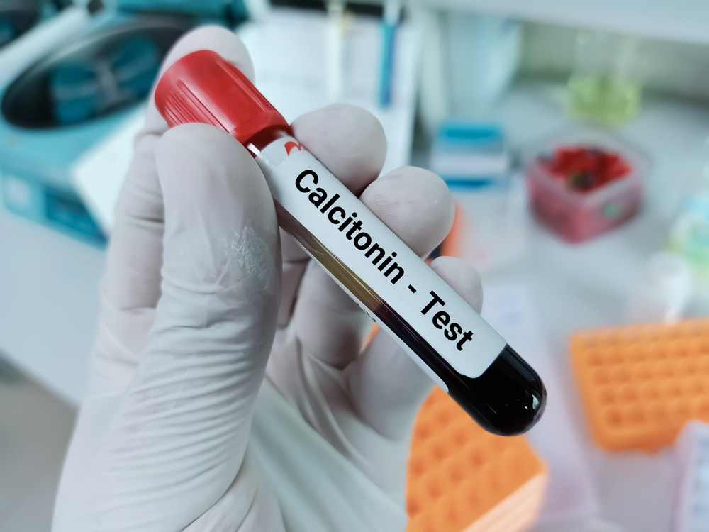 Quel taux de calcitonine est inquiétant ?