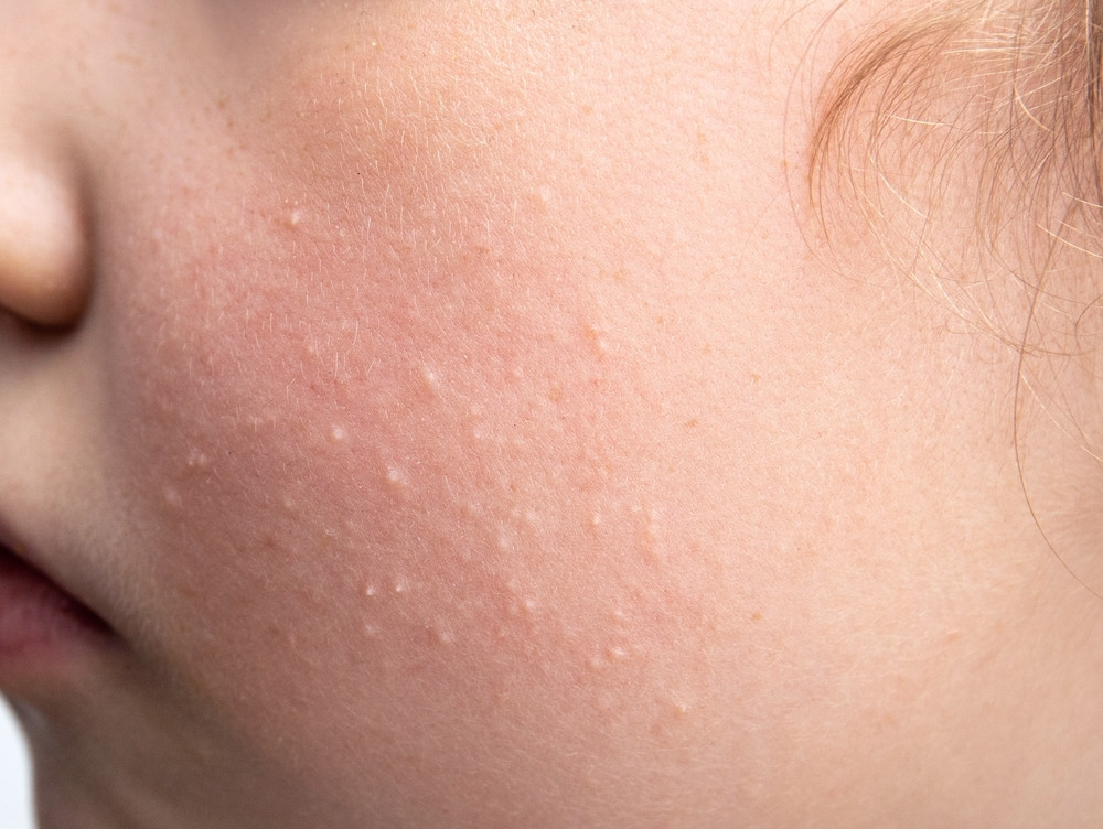 Microkystes : comment se débarrasser de ses boutons sous la peau ?