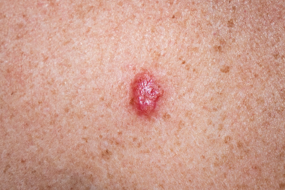 Les premiers signes d’un carcinome