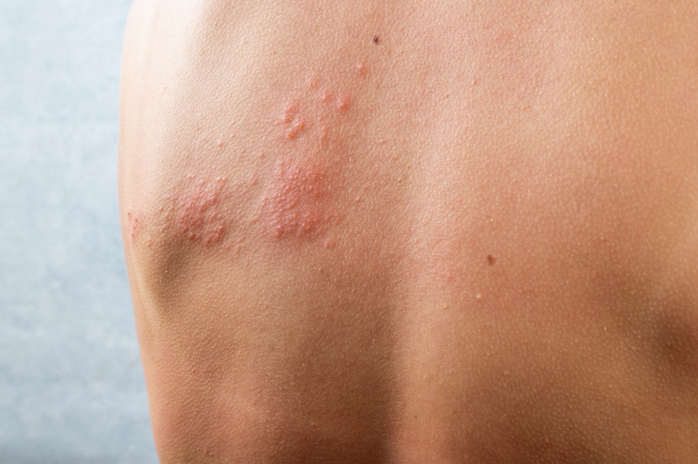 Zona : quels liens avec le cancer ?