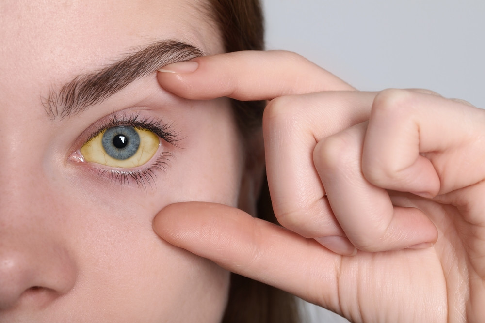 J’ai les yeux jaunes : c’est grave ?