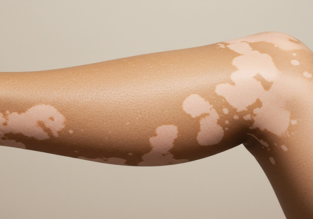 Qu'est-ce qui peut provoquer un vitiligo ?