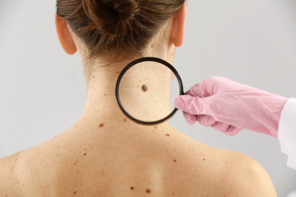 Quelle est l'espérance de vie pour le cancer de la peau ?