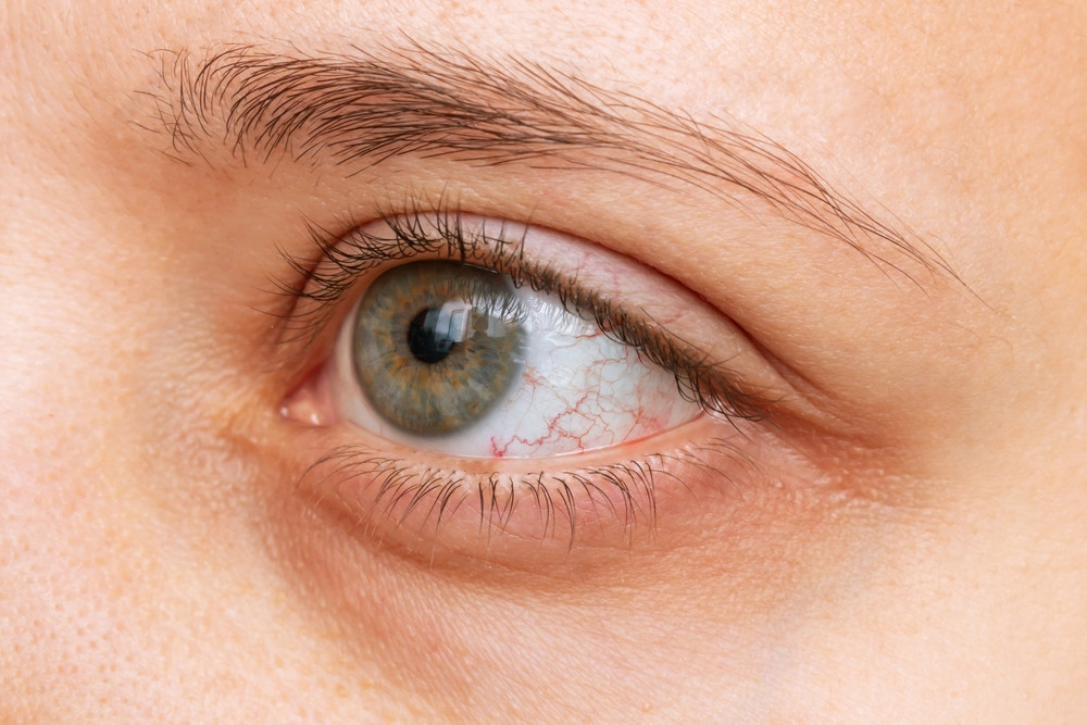 Sécheresse oculaire : quelles solutions ?