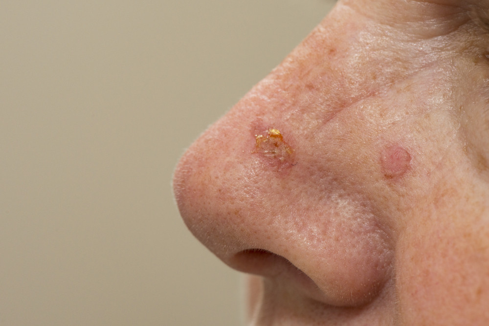 Cancer du nez : quels sont les premiers signes ?