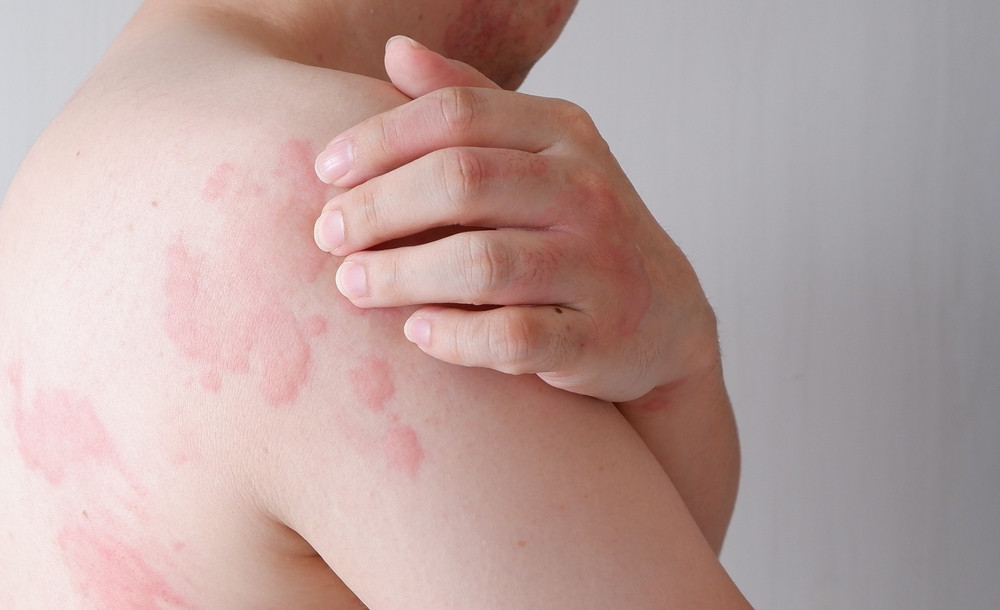 Intolérance à l’histamine : quels aliments éviter ?
