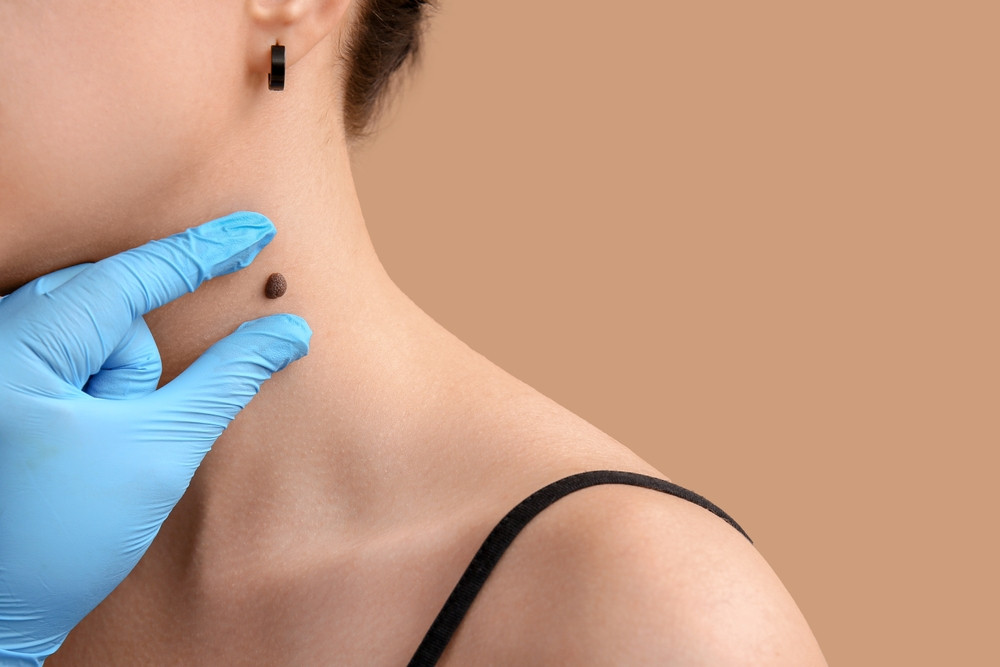10 symptômes où il faut rapidement consulter un dermatologue