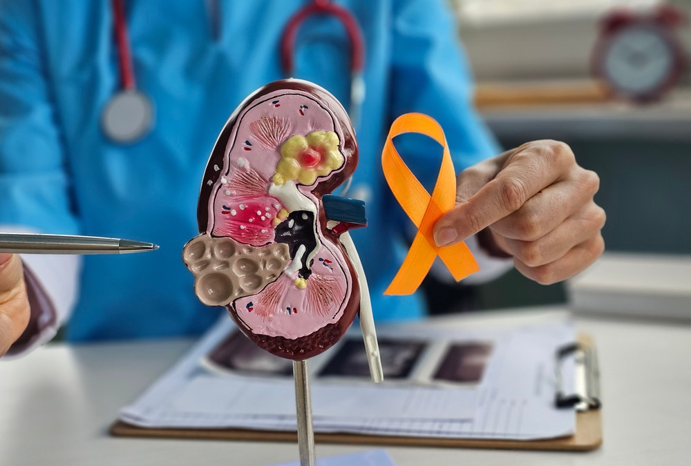 Quelle est l’espérance de vie quand on a un cancer du rein ?