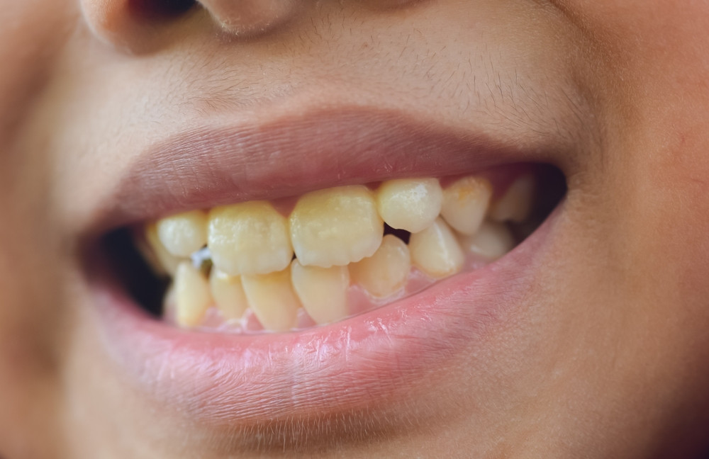 Dents jaunes : quelles solutions ?