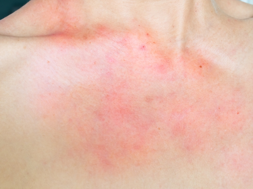 Quelle carence provoque de l'urticaire ?