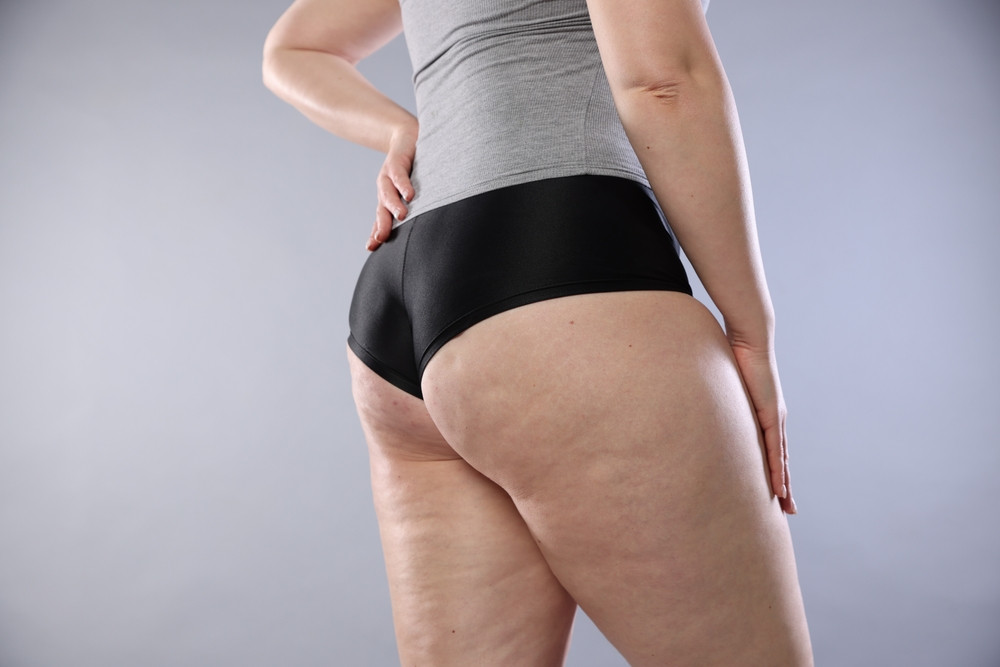 Pourquoi les femmes ont de la cellulite... et pas les hommes ?
