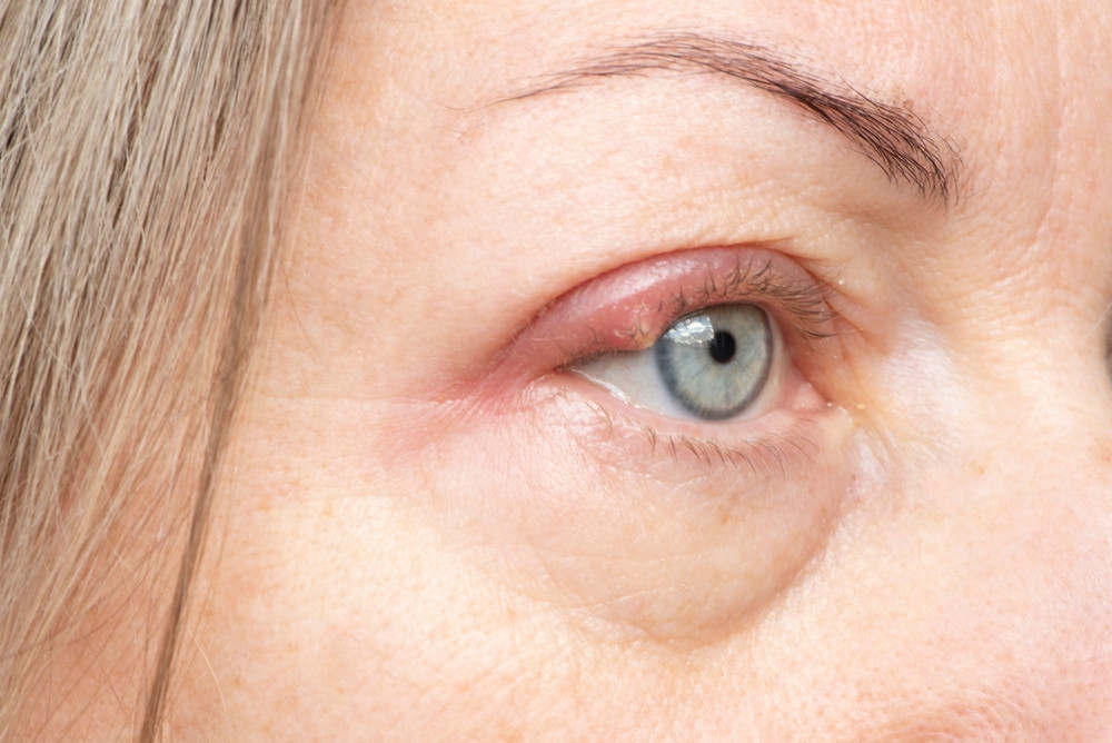 Comment soulager un orgelet à l’œil ?