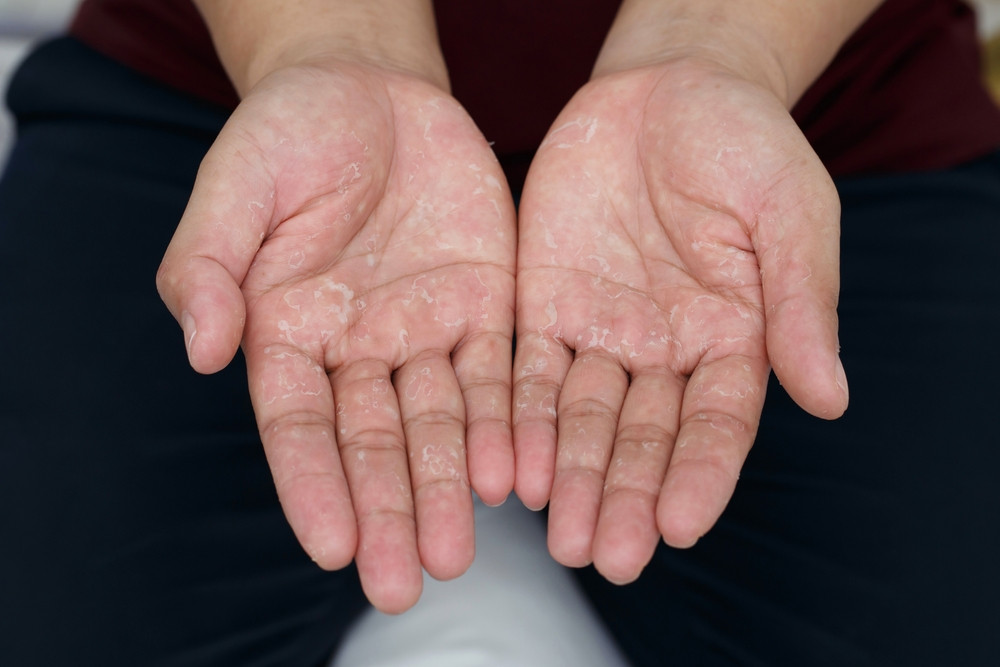 Tout savoir sur la dyshidrose