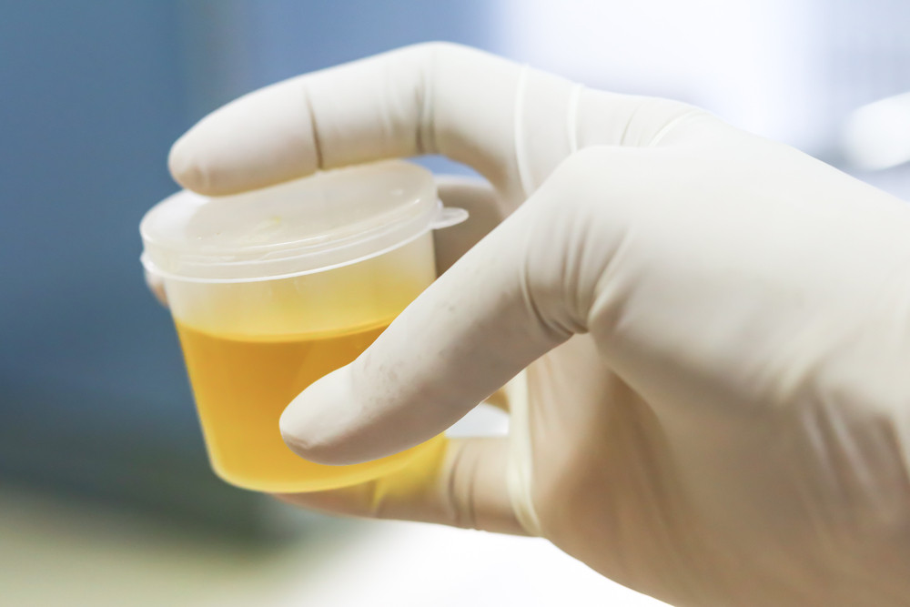 Urine mousseuse : un signe à ne pas négliger pour vos reins