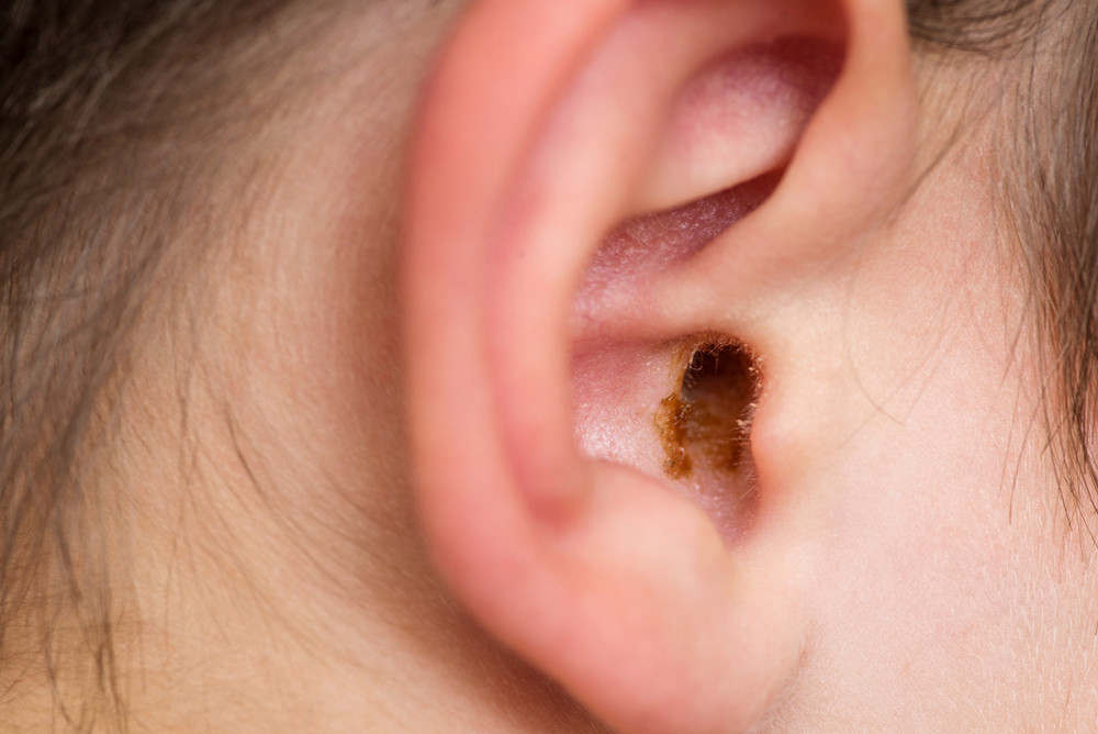 Comment enlever le cérumen de son oreille ?