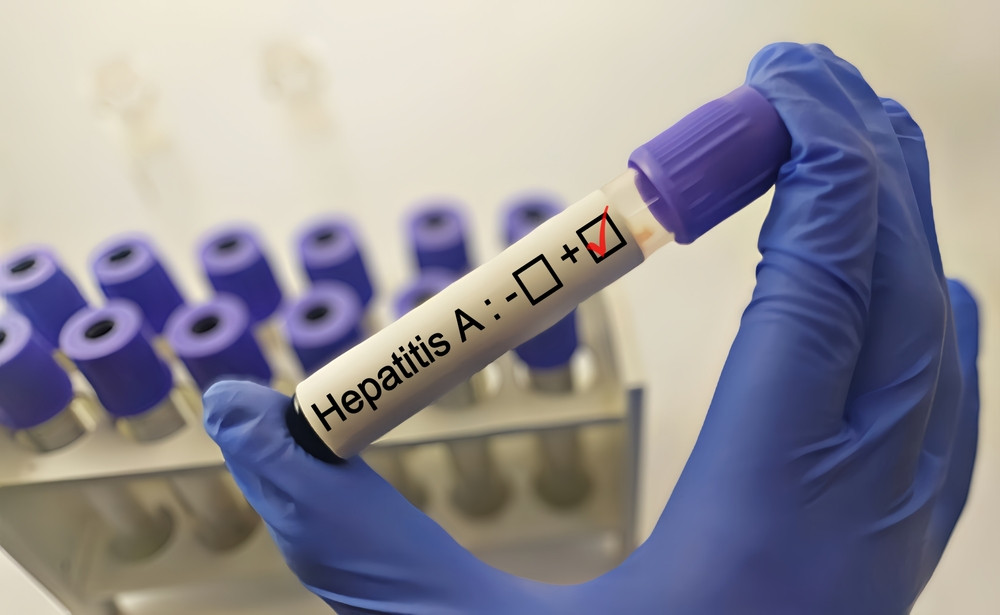 Tout savoir sur l’hépatite A