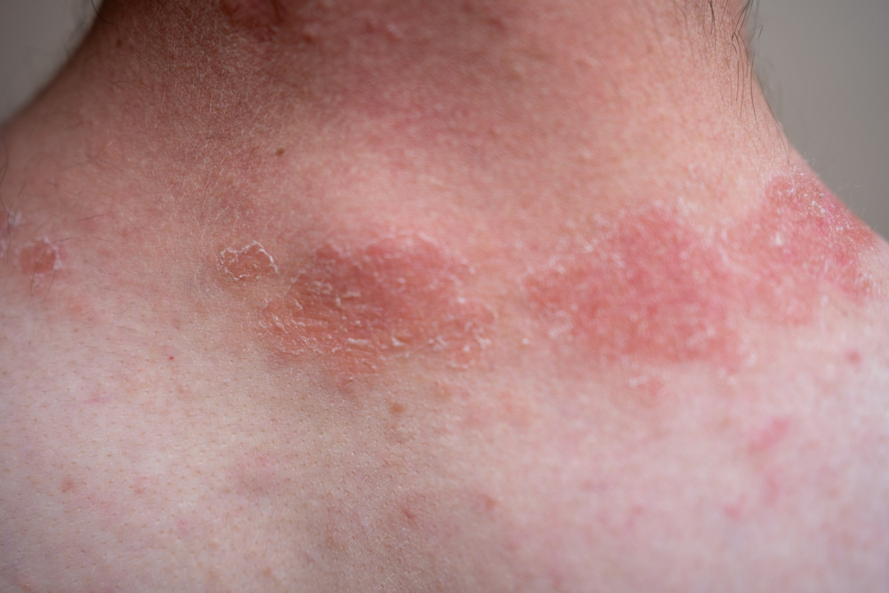 Comment distinguer eczéma et urticaire ?