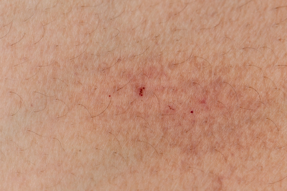 Comment se débarrasser d’un poil incarné ?